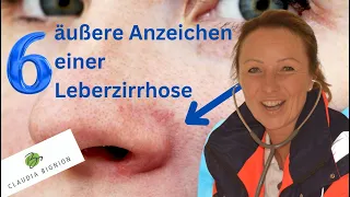 Leberzirrhose: Erkenne die Symptome dieser schweren Lebererkrankung (einfach erklärt)