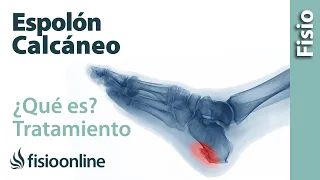 Espolón calcáneo dolor en el talón - Qué es, causas, síntomas y tratamiento