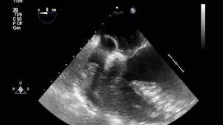 Two Videos Showing a Transesophageal Echocardiogram and a Saline-Contrast Echocardiogram