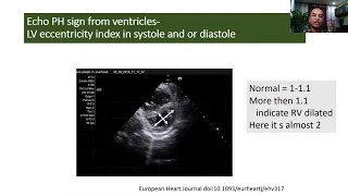 Philips Echo Webinar Series Echocardiographic Assessment in Pulmonary Hypertension by Dr  Abdul Mome