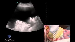 How To: Ultrasound Guided Paracentesis Procedure 3D Video