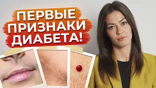 Как не допустить сахарный диабет? / Признаки сахарного диабета