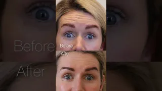 Botox before and after VIDEOs tell the real story