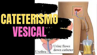 Cateterismo vesical de Demora masculino e feminino - cateterismo vesical material