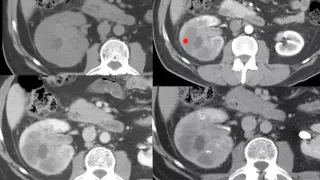 [AULA] Radiologia de nódulos renais e adrenais | Renal and adrenal nodules imaging