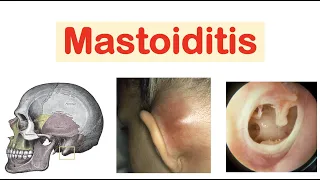 Mastoiditis (& Acute Otitis Media) | Causes, Pathophysiology, Symptoms, Diagnosis, Treatment