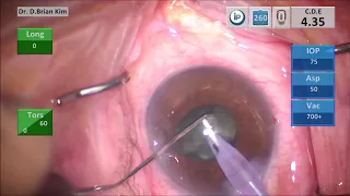 The Best Way to Do Cataract Surgery #3: Mechanical Fracturing in a Shrinking Pupil