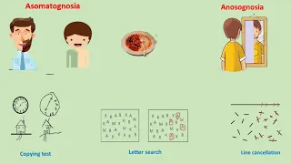 hemineglect syndrome | hemispatial neglect