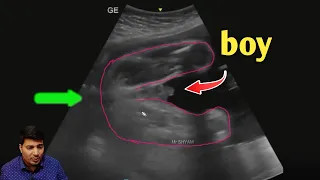 baby boy ultrasound /ultrasound report boy or girl in hindi / symptoms of baby boy