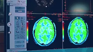 3D ASL (arterial spill labeling) non CE brain perfusion on GE 1.5t with full detail post processing.