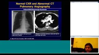 Pulmonary hypertension by Dr Usha Krishnan