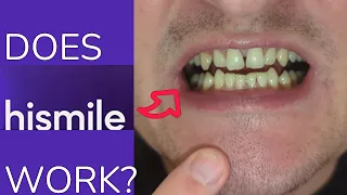 HISMILE Teeth Whitening Review