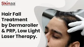 PRP Therapy with Dermaroller Treatment for Hair Loss at Skinaa Clinic
