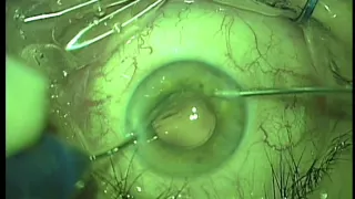 Факоэмульсификация катаракты (ФЭК) с имплантацией ИОЛ