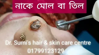 নাকে মোল বা তিল অপসারণ ||  Mole || তিল || 01799123129 || Dr. Ummay Habiba Sumi ||