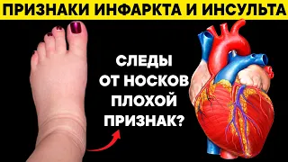 12 ранних признаков того, что у Вас проблемы с СЕРДЦЕМ. Как вовремя выявить ИНФАРКТ и ИНСУЛЬТ