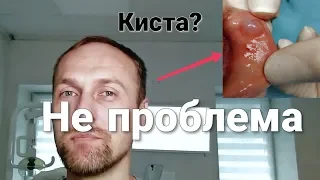 Шарик На Губе. Что Это Такое И Что Делать?