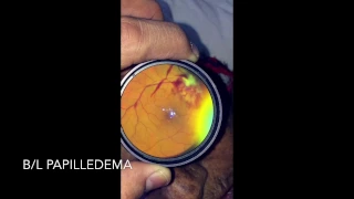 Papilloedema- Indirect ophthalmoscopy through iPhone - without adapter