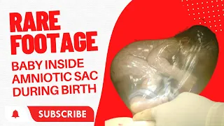 Rare Footage: Baby Inside Amniotic Sac During Birth!