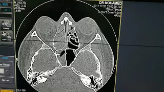 PNS CT مقطعية الجيوب الأنفيه