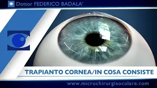 Trapianto di Cornea: in Cosa Consiste e Quali Novità