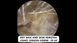 DRY SKIN AND EAR WAX REMOVAL USING JOBSON HORNE - EP 69