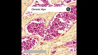Chronic Myeloid Leukemia EN