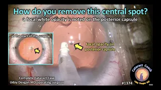 CataractCoach 1374: how do you remove this central spot on the capsule?