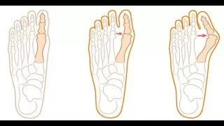 Как избавиться от вальгусной деформации Hallux Valgus.