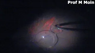 Retrieving a Dropped IOL under Oil