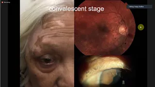 Ocular Manifestations of Systemic Autoimmune Diseases