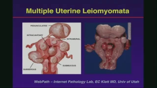 Ultrasound of the Uterus and Endometrium