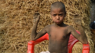 Bangladeshi Child Turning Into Stone