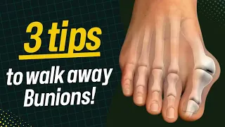 3 Tips for Bunions