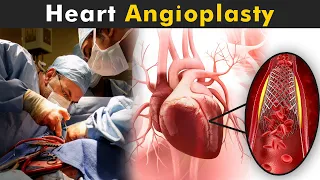 How Angioplasty Procedure Is Performed? | Balloon Angioplasty And Coronary artery stent (Urdu/Hindi)