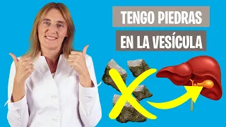 DIETA para las PIEDRAS en la VESÍCULA | Qué comer con colelitiasis | Nutrición clínica