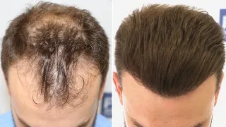 FUE Hair Transplant (3052 Grafts NW III-VI Vertex) By Dr Juan Couto - FUEXPERT CLINIC, Madrid, Spain