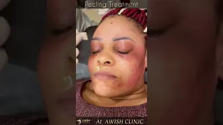 Peeling Treatment  for under eye pigmentation At AWISH Clinic by Dr. Vijay Kumar #awishclinic #short