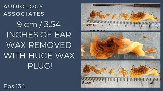 9CM/3.5 INCHES OF EAR WAX REMOVED WITH HUGE PLUG - EP 134