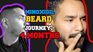 MINOXIDIL BEARD JOURNEY [4 MONTHS]