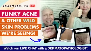 #Skinsights LIVE: Funky Acne & Other WILD Skin Problems We’re Seeing!