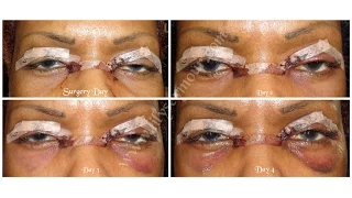 Part 2: Hooded Eyelid Surgery | Blepharoplasty | Day 1 - 8 Post-op