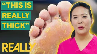 Marion Advises A Patient Not To Use A Blade For Calluses  | The Bad Foot Clinic | Brand New Series