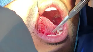 Ranula sublingual