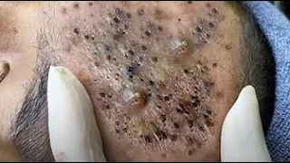 BEST Pimple Popping // Big Cystic Acne Blackheads // Whiteheads Removal / Squeezing Pimples / #002