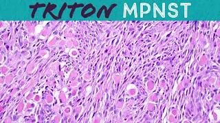 Malignant Triton tumor (MPNST with rhabdomyosarcoma differentiation): Basic soft tissue pathology