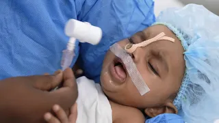 Baby waking up after Surgery - Extubation Procedure