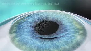 What is LASIK?