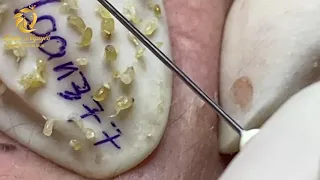 Blackheads removal and pimple poping (377) | Loan Nguyen