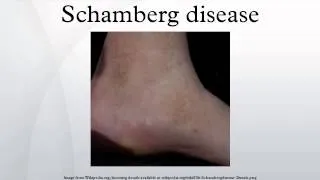 Schamberg disease